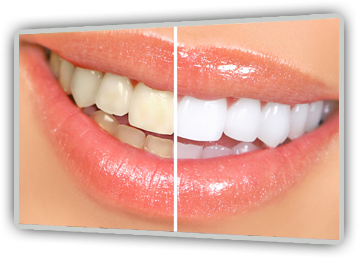 Teeth Whitening Before & After